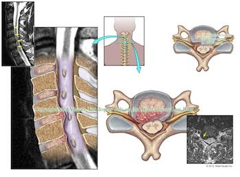 Cervical Disc