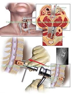 Cervical Disc