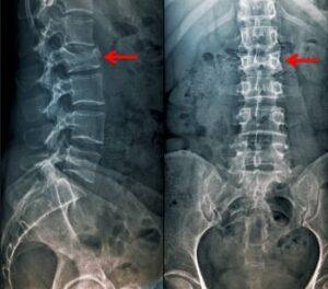 lumbar compression fracture