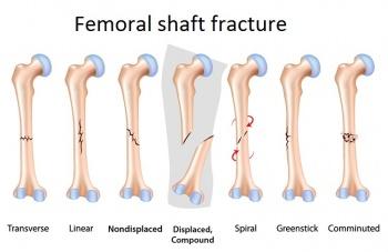 Femoral Fractures - Physiopedia